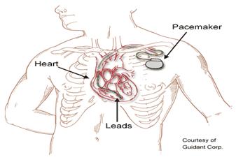 Pacemaker illustration