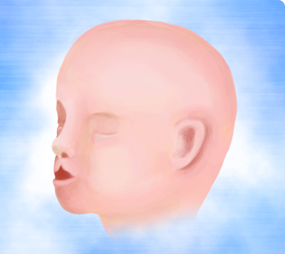 baby with cleft