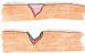 Click to see graphic of the Lozacote Bandage.