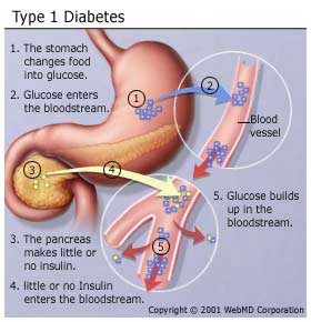 Type 1 Diabetes